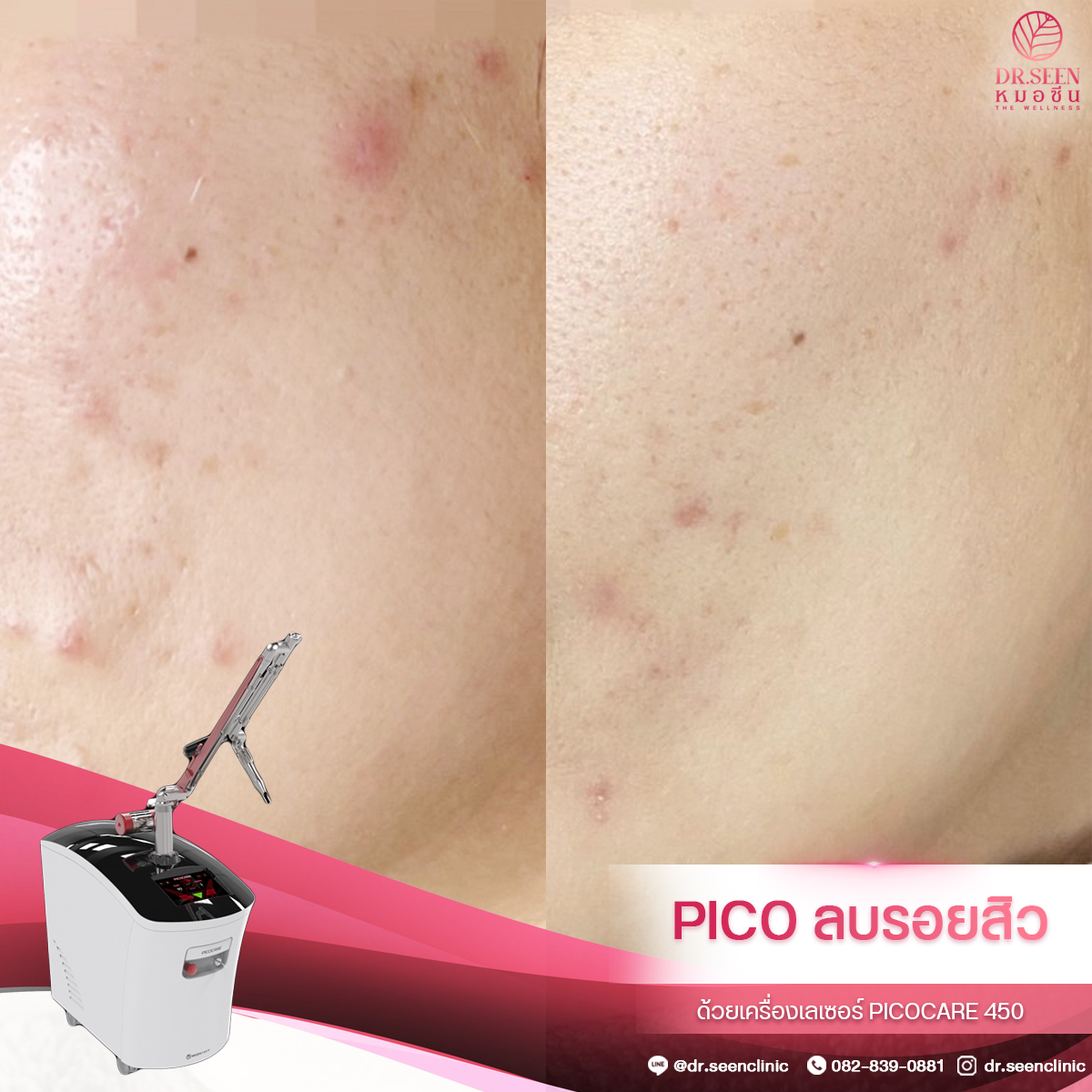 กรอบ PICO 1