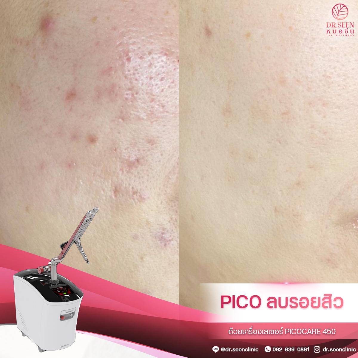 กรอบ PICO 2