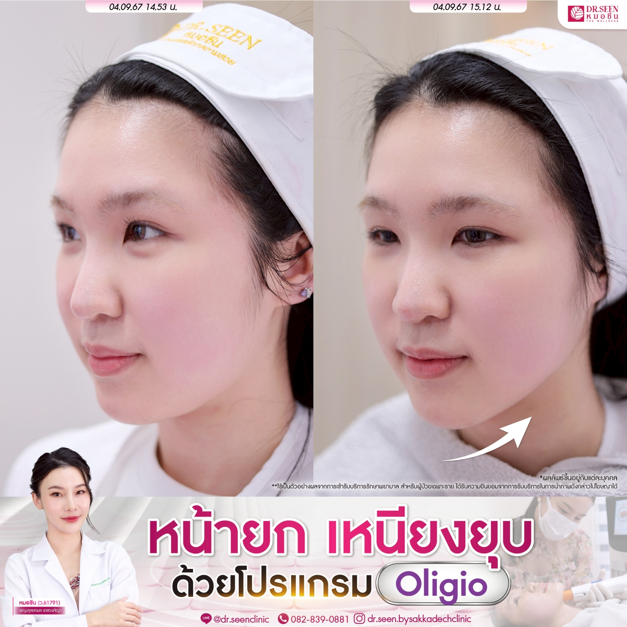 LINE_ALBUM_ความรู้ Oligio + รีวิว_250912_3