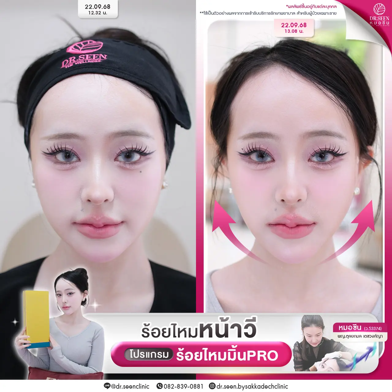 โปรแกรมร้อยไหม โดย Dr.Seen หมอซีน by คลินิกเวชกรรมหมอสักกาเดช