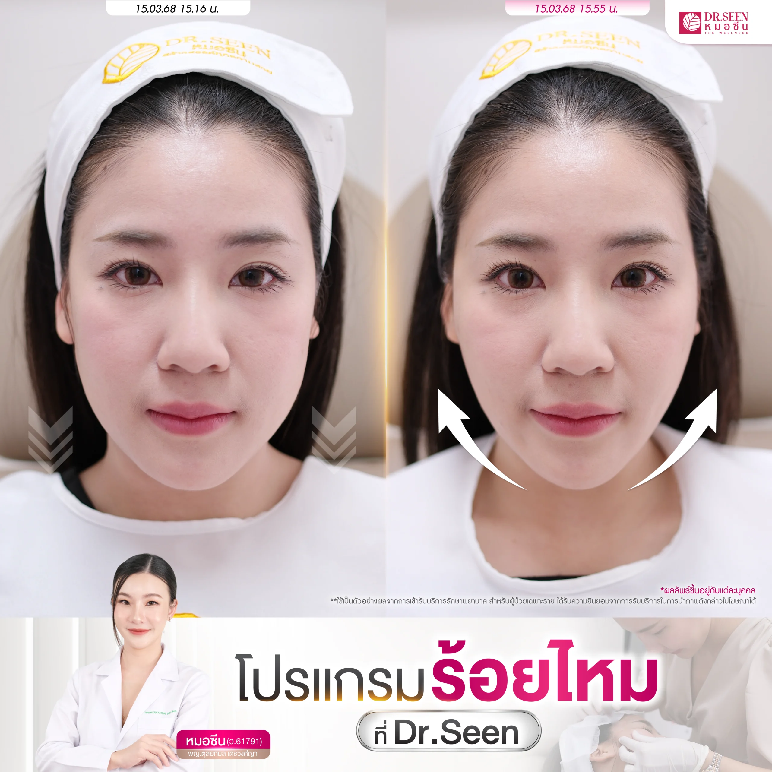 โปรแกรมร้อยไหม โดย Dr.Seen หมอซีน by คลินิกเวชกรรมหมอสักกาเดช