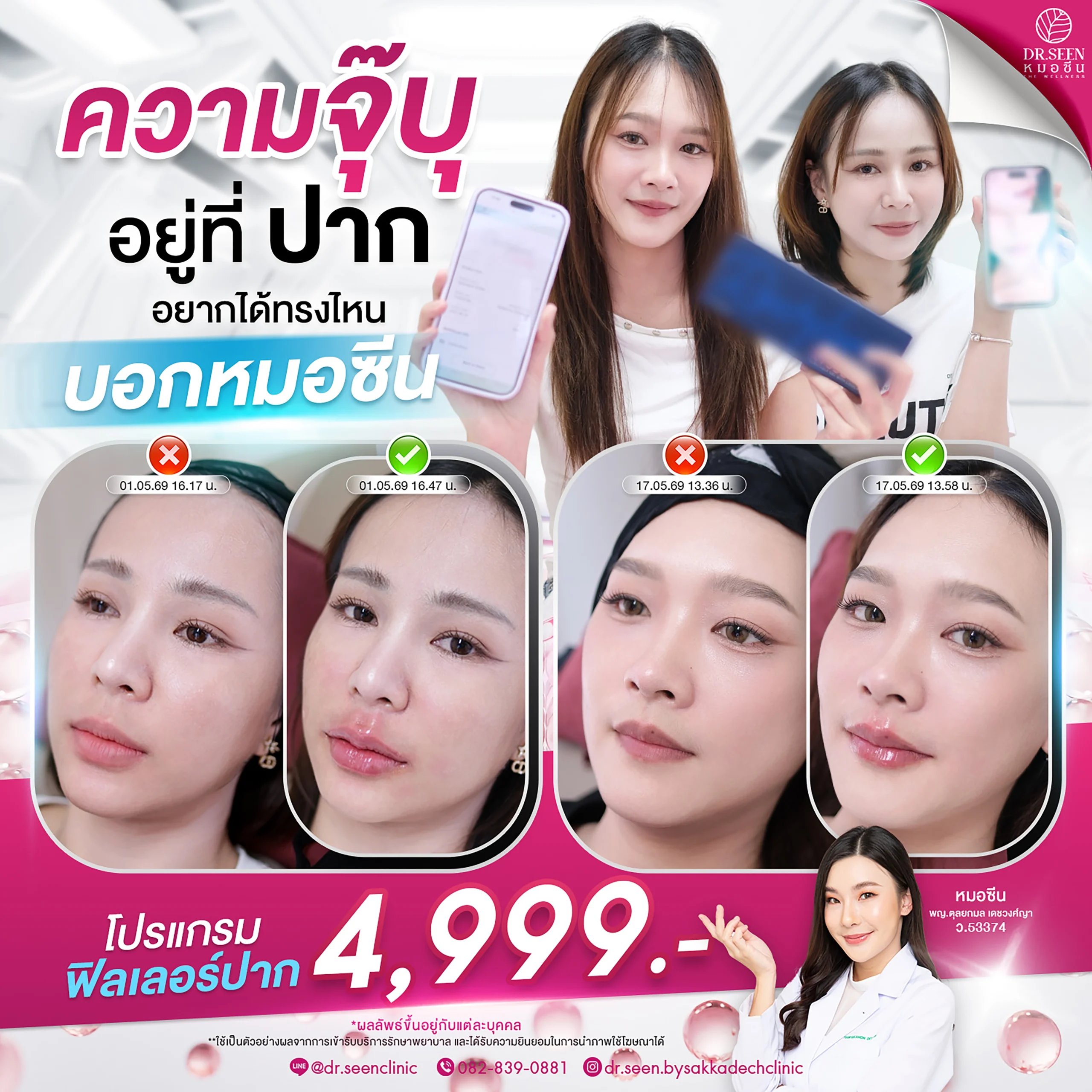 Dr.Seen หมอซีน by คลินิกเวชกรรมหมอสักกาเดช โปรแกรมฟิลเลอร์ปาก