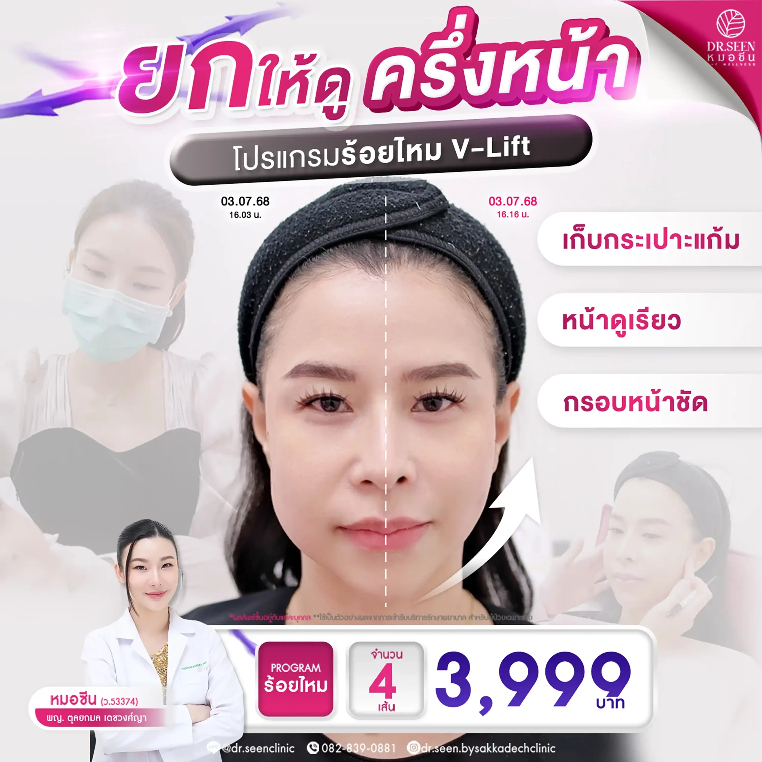 "โปรโมชั่น ร้อยไหม V-Lift ยกกระชับใบหน้าครึ่งหน้า เก็บกระเปาะแก้ม ให้หน้าเรียว กรอบหน้าชัด by Dr. Seen Clinic ราคา 3,999 บาท"