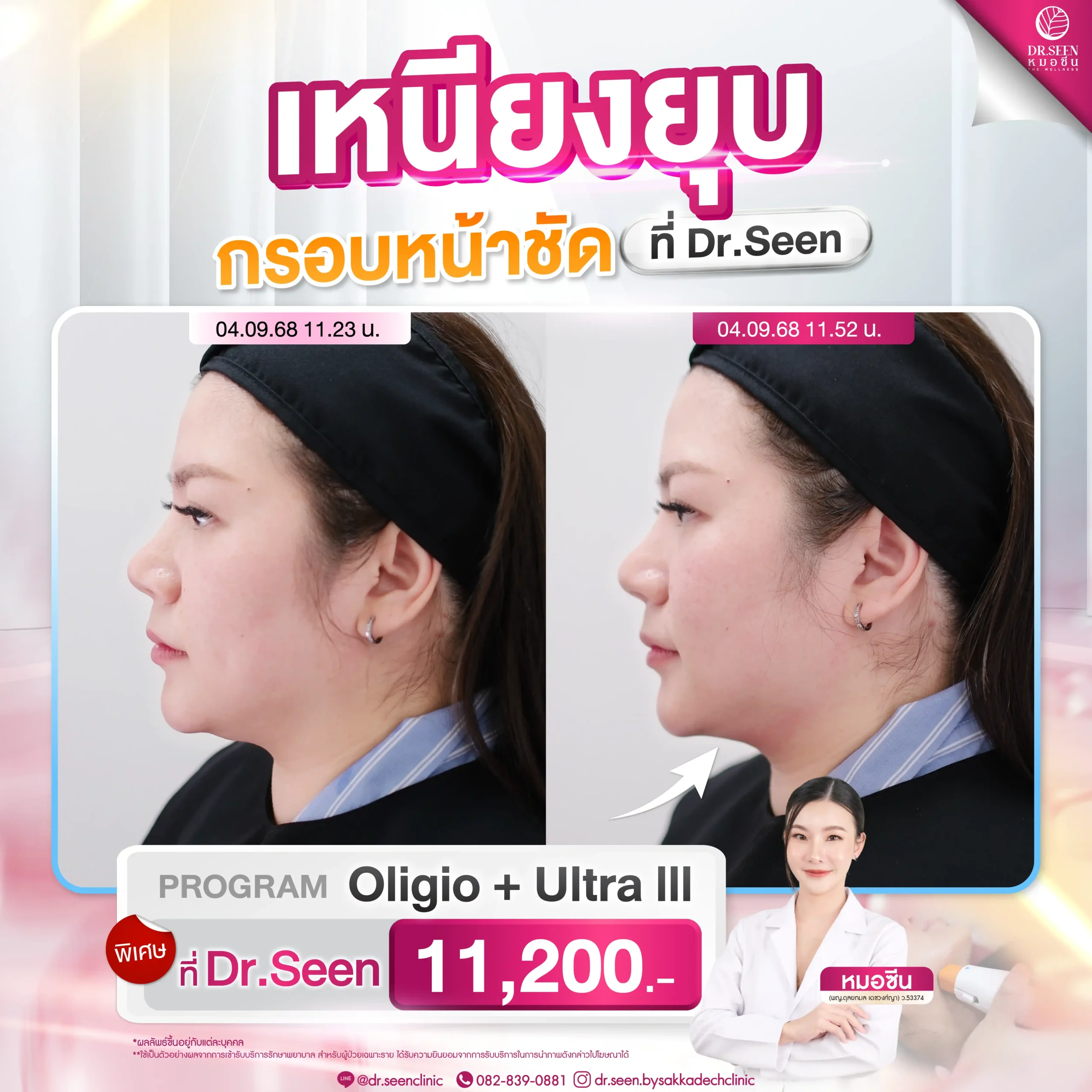 ผลลัพธ์ Before After โปรแกรม Oligio Ultra III ลดเหนียง ยกกระชับกรอบหน้าชัด by Dr. Seen Clinic