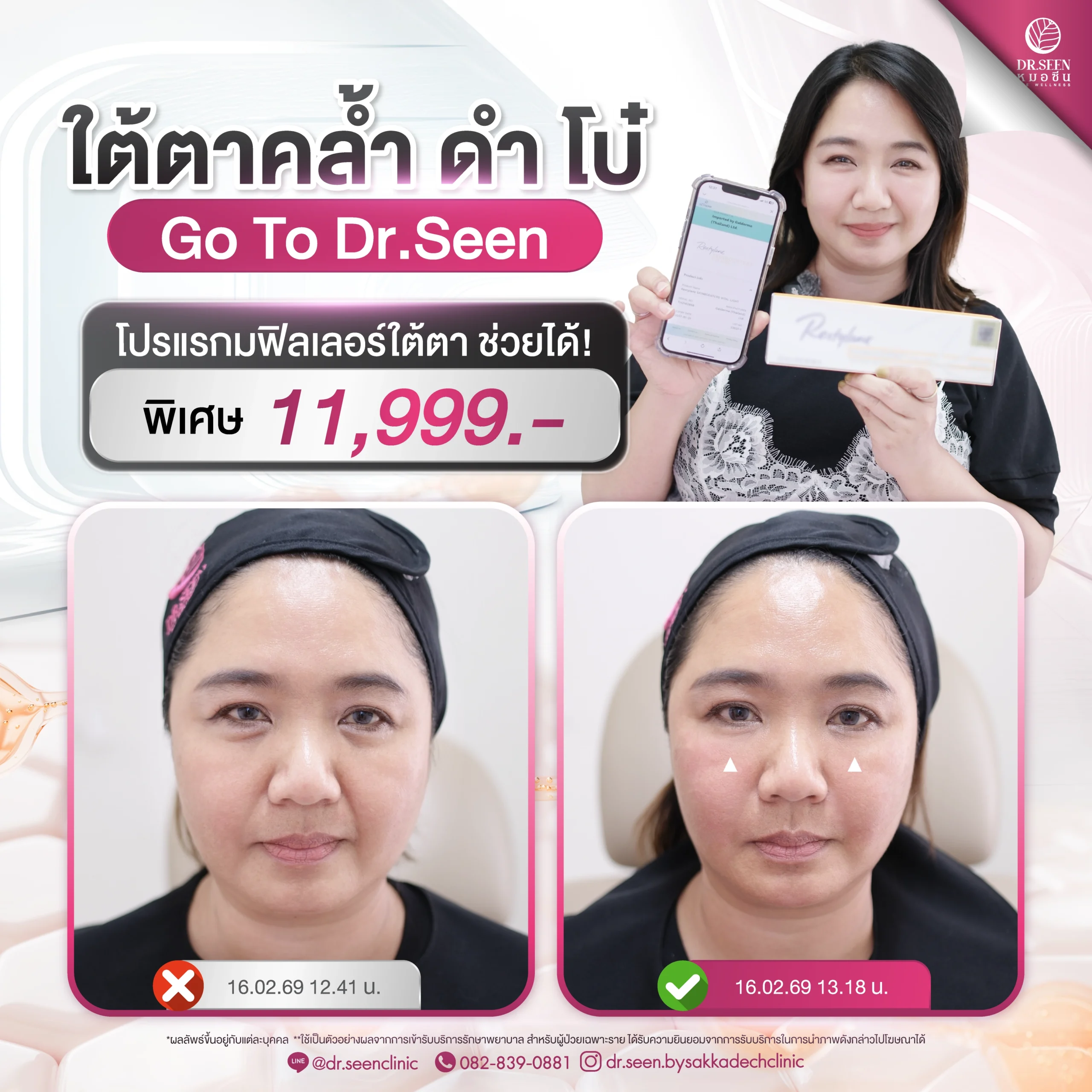 "โปรแกรมฟิลเลอร์ใต้ตา แก้ปัญหาใต้ตาคล้ำ เติมเต็มร่องลึก ให้ใต้ตาสดใส by Dr. Seen Clinic ราคา 11,900 บาท"