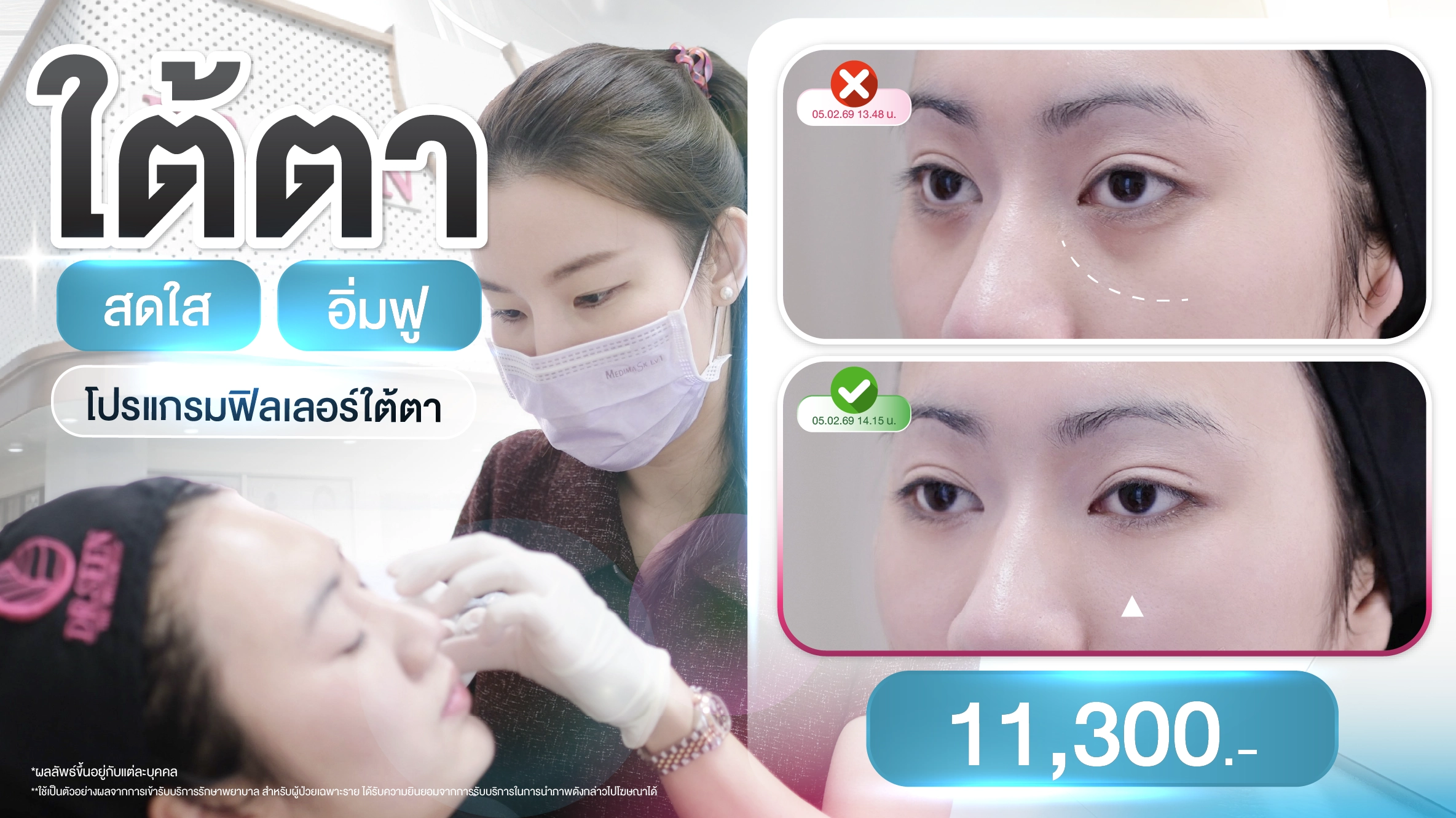 หลายคนสงสัยกันมาเยอะมากว่าอลลี่อายกับถุงใต้ตามันคืออันเดียวกันไม่ใช่หรอ? แต่ความเป็นจริงแล้วมันคนละขั่วเลยค่ะ