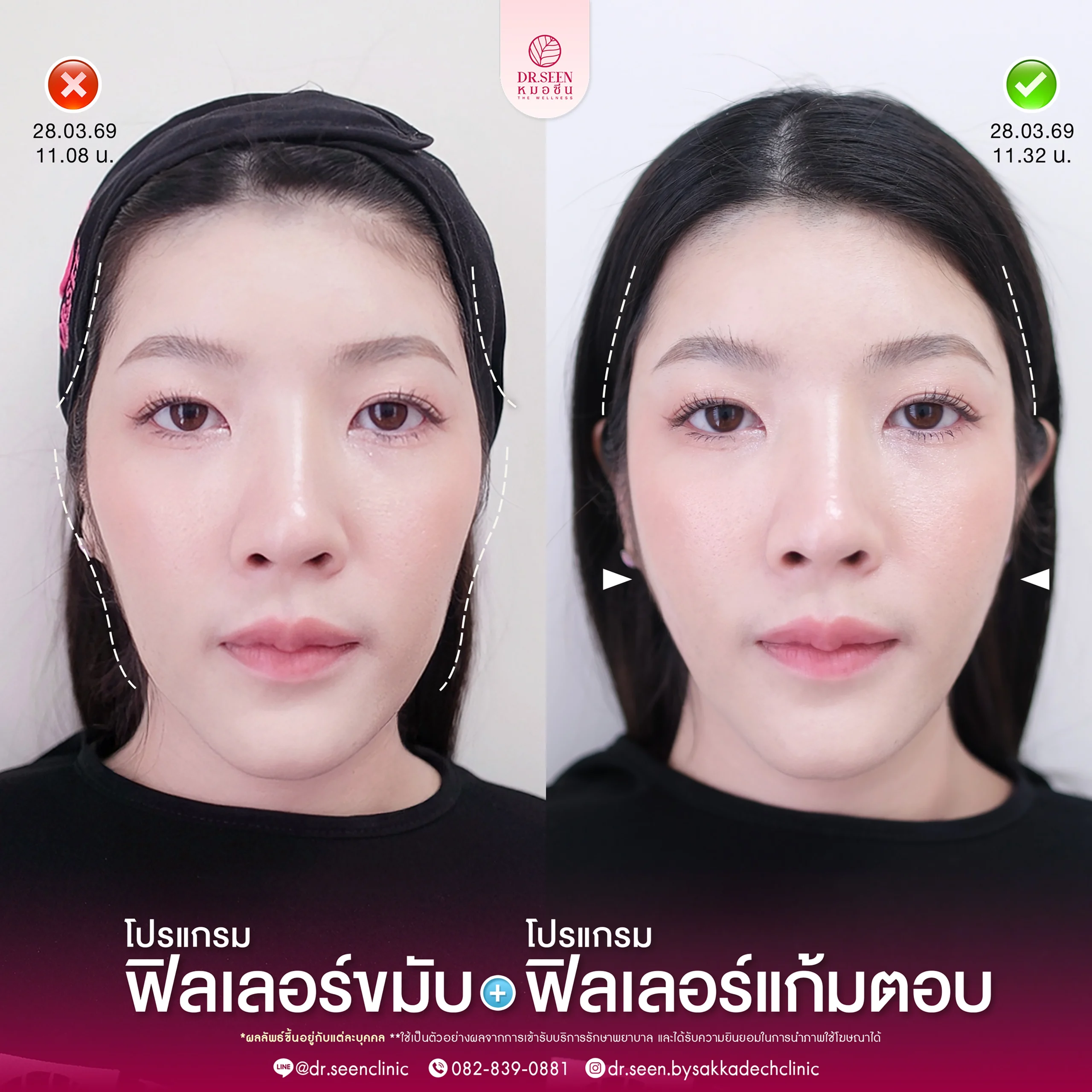 รีวิวฟิลเลอร์ Yvoire ใต้ตา , รีวิวฟิลเลอร์ Yvoire แก้มตอบ, รีวิวฟิลเลอร์ Yvoire ขมับ, รีวิวฟิลเลอร์ Yvoire ปาก , รีวิวฟิลเลอร์ Yvoire คาง