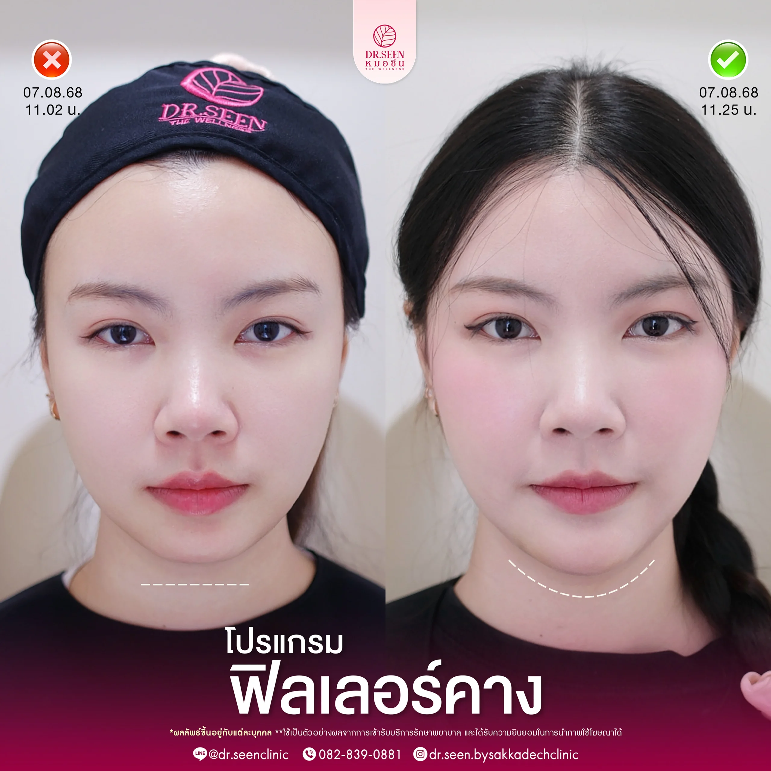 รีวิวฟิลเลอร์ Yvoire ใต้ตา , รีวิวฟิลเลอร์ Yvoire แก้มตอบ, รีวิวฟิลเลอร์ Yvoire ขมับ, รีวิวฟิลเลอร์ Yvoire ปาก , รีวิวฟิลเลอร์ Yvoire คาง