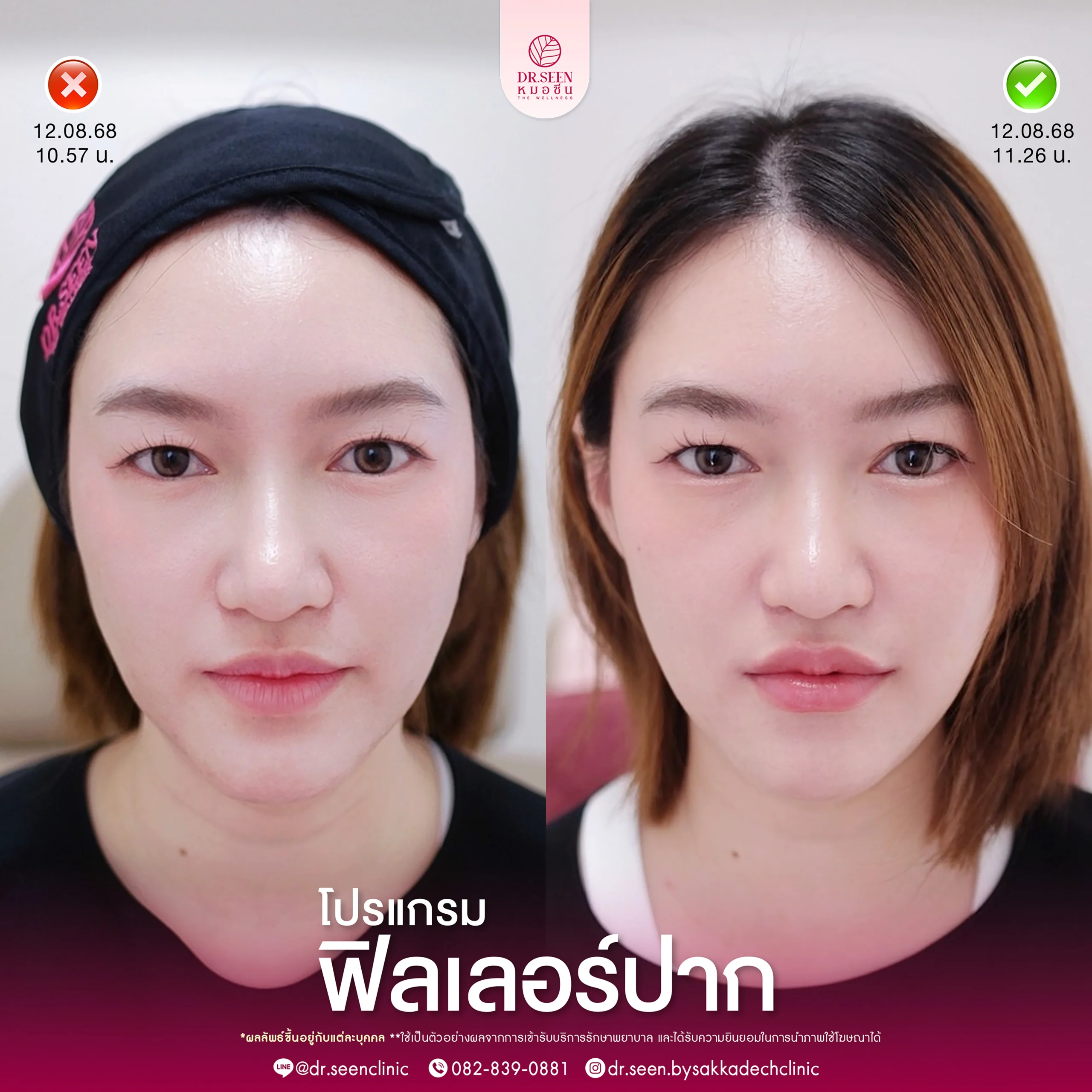 รีวิวฟิลเลอร์ Yvoire ใต้ตา , รีวิวฟิลเลอร์ Yvoire แก้มตอบ, รีวิวฟิลเลอร์ Yvoire ขมับ, รีวิวฟิลเลอร์ Yvoire ปาก , รีวิวฟิลเลอร์ Yvoire คาง