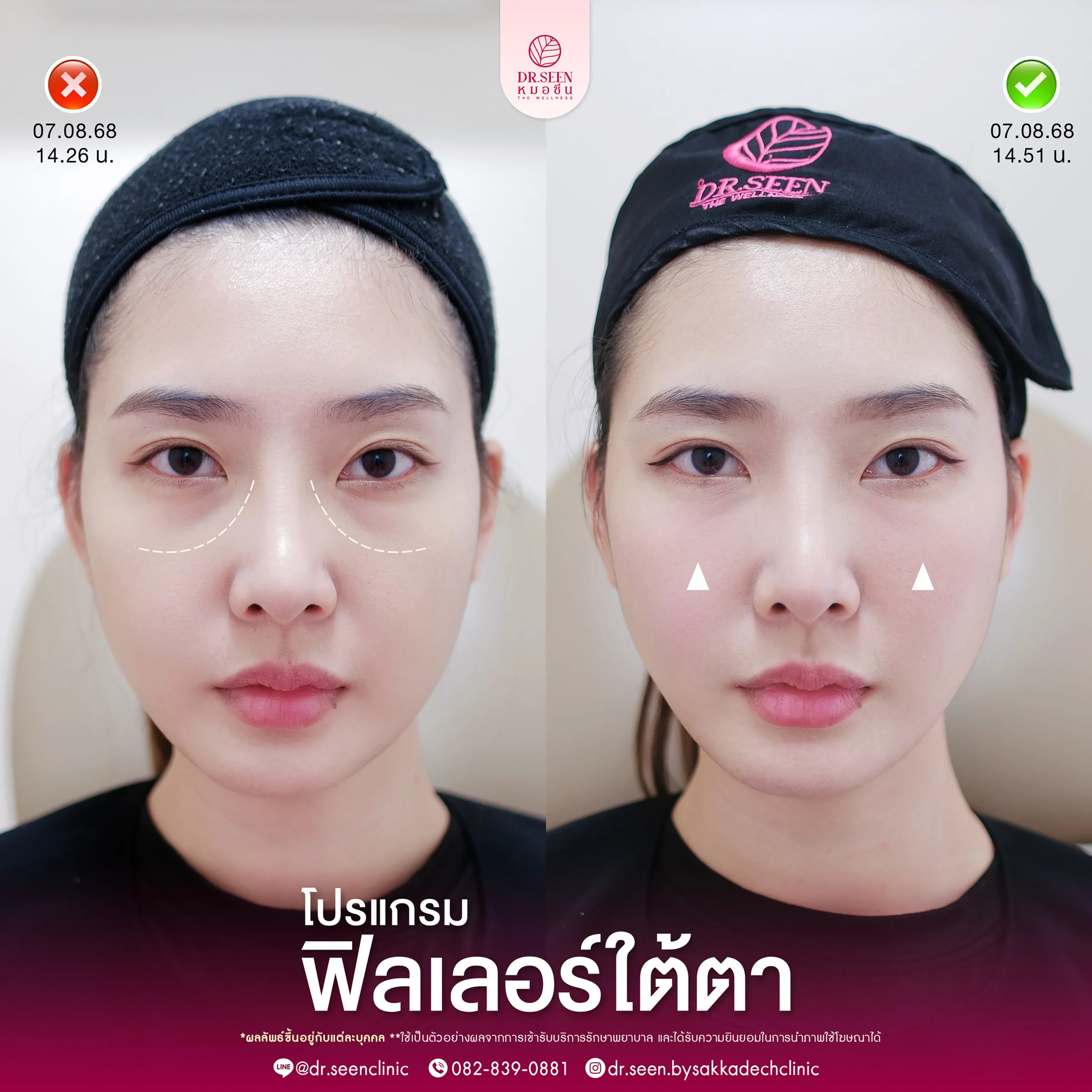 รีวิวฟิลเลอร์ Yvoire ใต้ตา , รีวิวฟิลเลอร์ Yvoire แก้มตอบ, รีวิวฟิลเลอร์ Yvoire ขมับ, รีวิวฟิลเลอร์ Yvoire ปาก , รีวิวฟิลเลอร์ Yvoire คาง