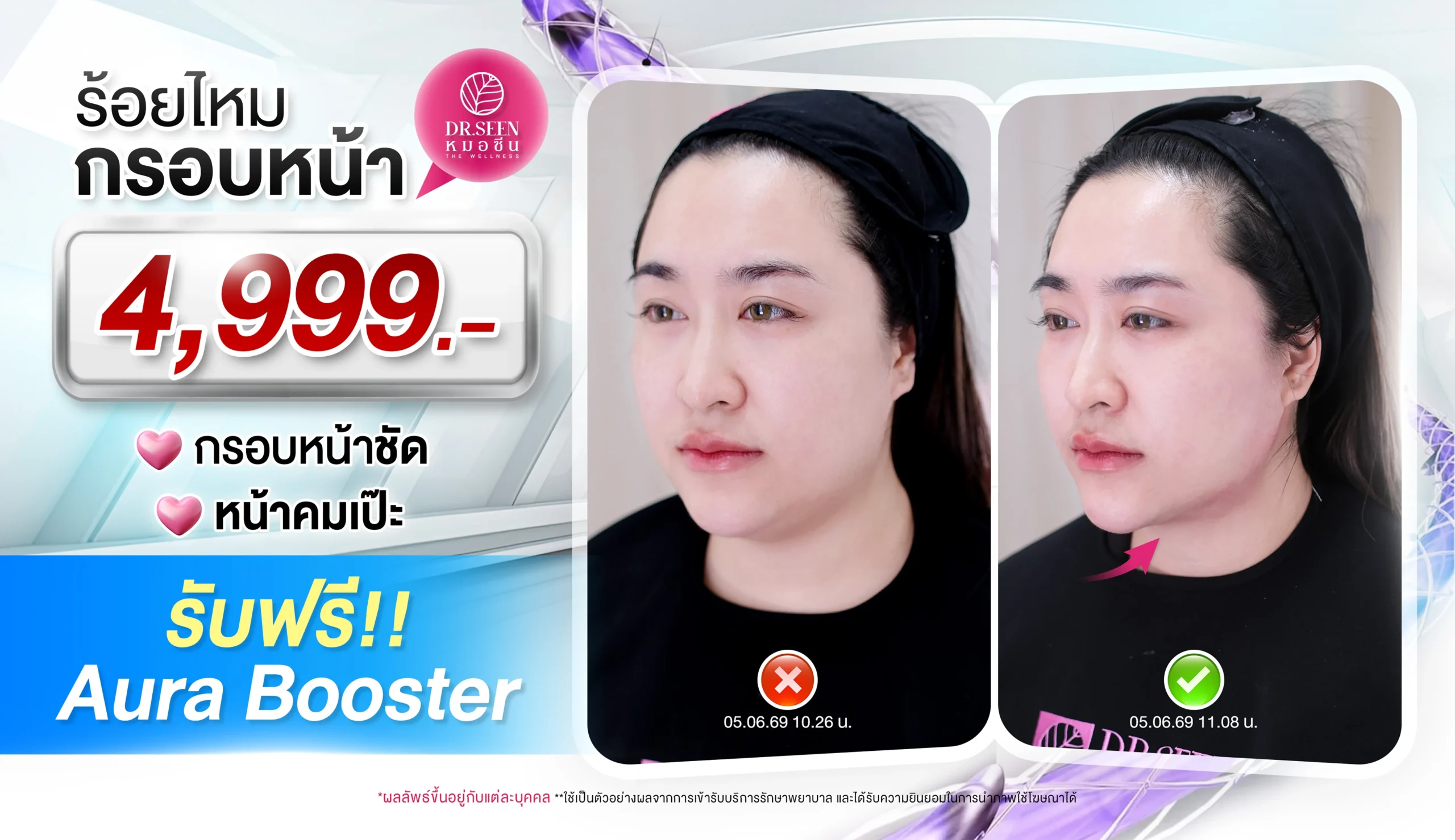 โปรแกรมร้อยไหมกรอบหน้า - กรอบหน้าชัด หน้าคมเป๊ะ - Dr.Seen